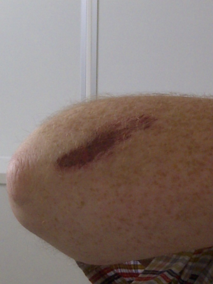 So sieht mein linker Arm nun aus